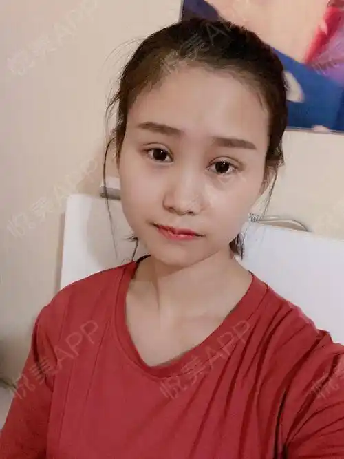 眼部多项术后20天_全切双眼皮术后20天_眼型矫正术后20天_眼部多项术