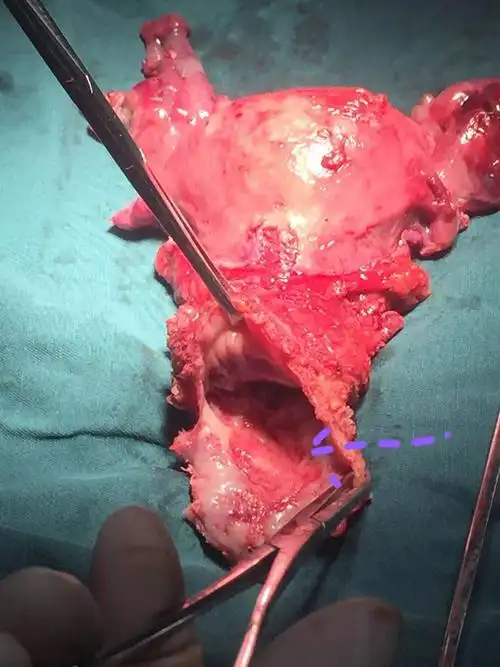 没有任何症状,50岁的她却得了罕见病