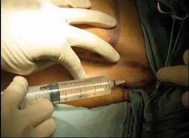 实拍泰国人妖变性手术全过程真的很痛