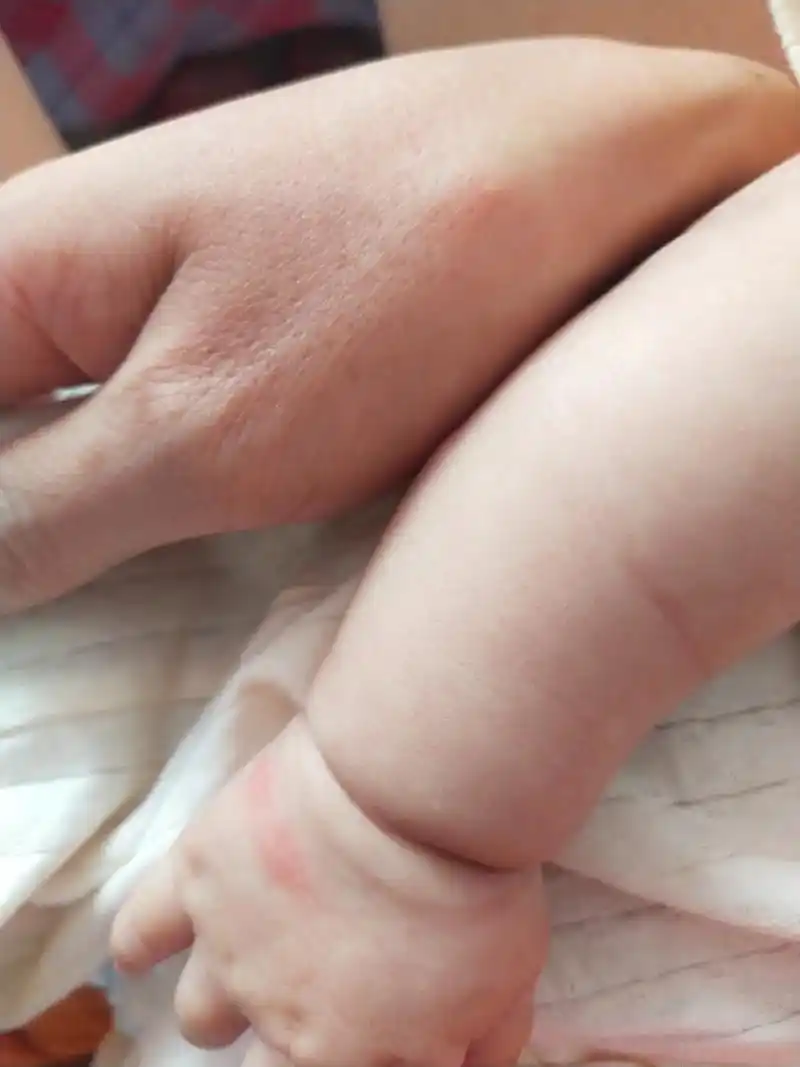 听说总胆汁酸高的症状就是皮肤痒,快生的一个星期前,总胆汁酸升 - 抖