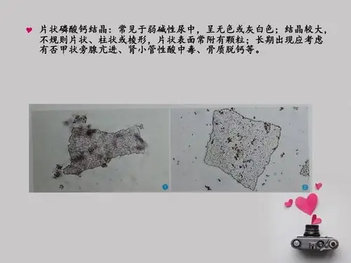 尿结晶检查