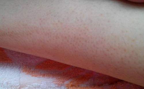 腿上毛孔堵塞该怎么办?腿上毛孔长小颗粒该怎么办?[图]