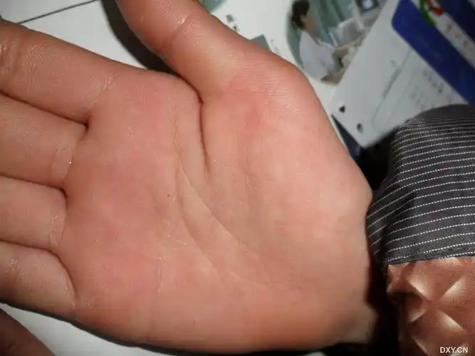 【病例讨论】掌跖点状角化症手背面也会有皮疹么?