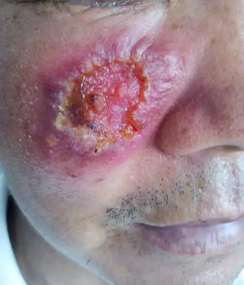 【病例讨论】面部溃疡 - 皮肤性病 -丁香园论坛