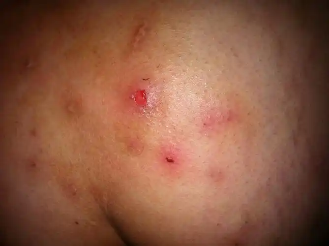 这个是毛囊炎么?