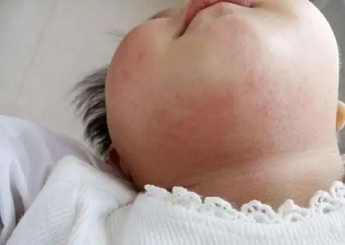 回答你好,宝宝的情况可能是湿疹,属于过敏性疾病,建议在医师的详细