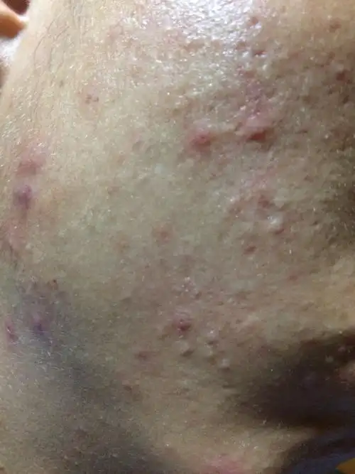 匿名| 浏览 6 次 毛囊炎,可以用百多邦或者红霉素软膏加消炎药  本