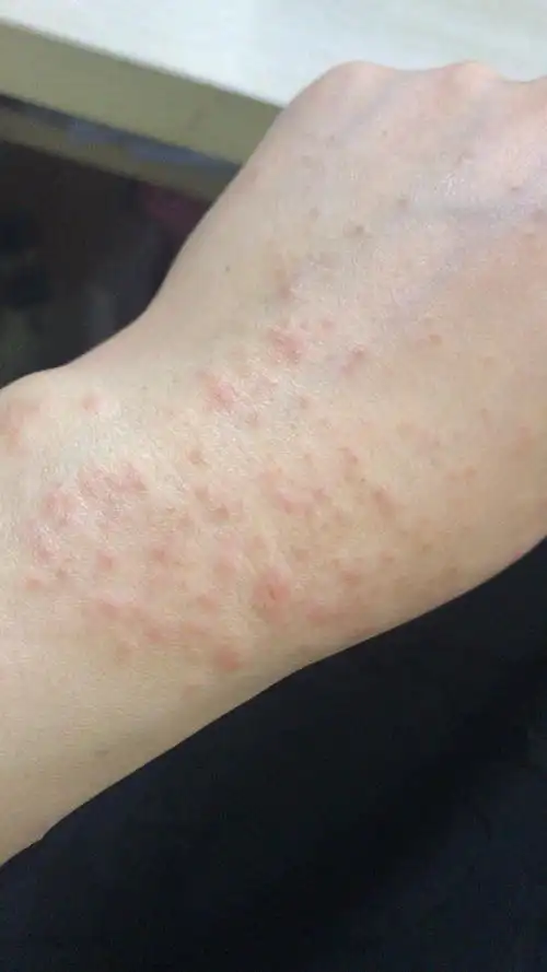 叫了很多年的"湿疹",原来还不是一种病?