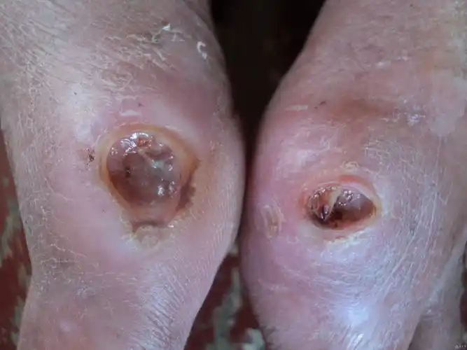 慢性皮肤溃疡就不愈合