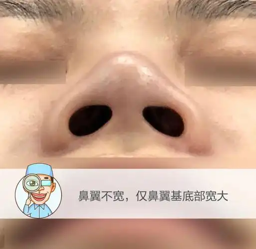 鼻翼太宽就要切除不一定具体要根据造成鼻翼肥大的原因来判断