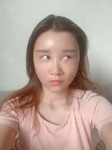 自体脂肪填充全脸第3天,消肿啦~真的消了很多,这几_圈子-新氧美容整形