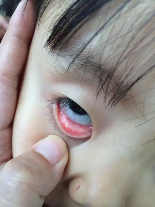 囡囡眼睛里长了一颗小白点,有谁知道这是什么?跪谢!