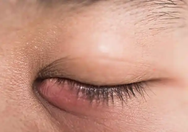 水肿图片慢性肾炎水肿图片肾病眼睑浮肿/水肿图片肾病早期面部水肿