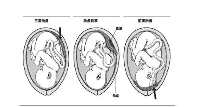 胎盘正常附着位置有哪些?相对于女性而言,子宫就像个立体