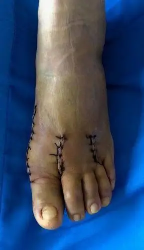 拇外翻的治疗 (原创)