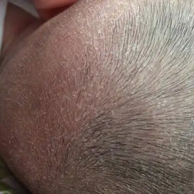 宝宝两个半月了,头上老是起皮,都有涂bb油的