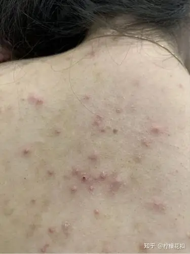 用过维肤膏,用过治皮炎的膏都没什么效果,已经留下了很多痘印.