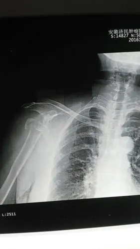 我院完成肩关节置换手术