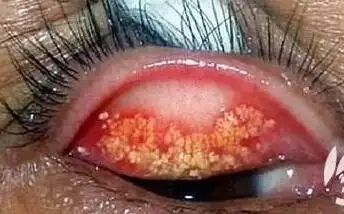 女子眼睛挖出石头 画面太惊悚有图有视频(慎点)