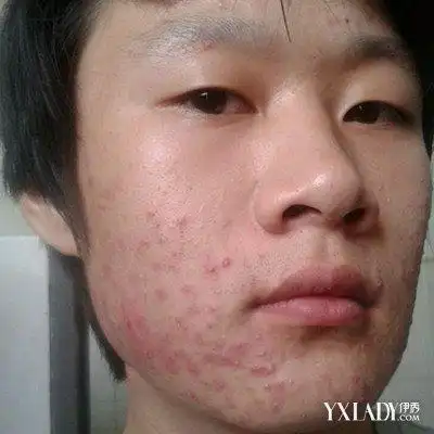 你了解面部毛囊炎图片吗分享如何预防和治疗面部毛囊炎