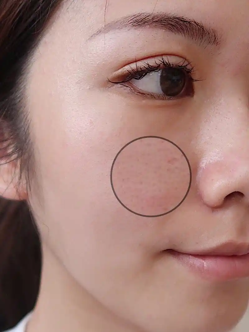 很多女生私信问我 毛孔大咋办呢?