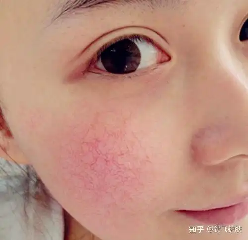 角质层比较薄皮肤敏感经受不住刺激的原因