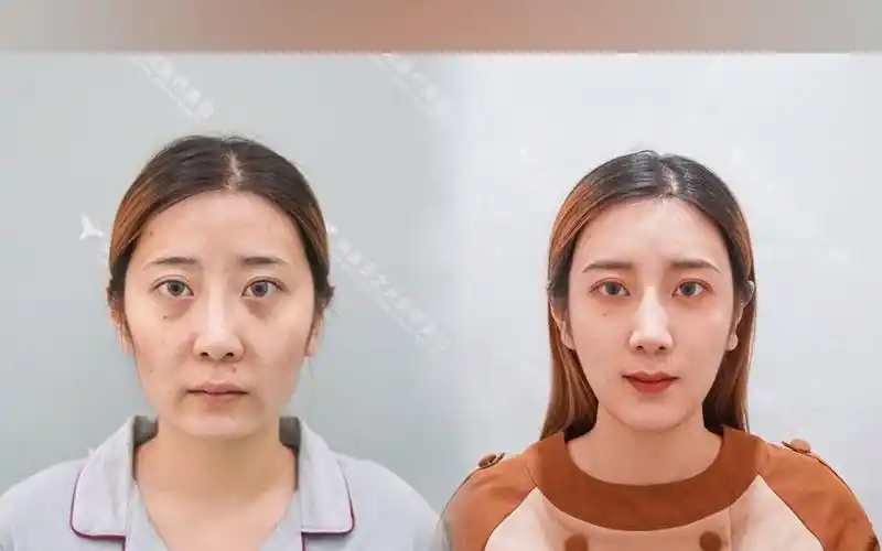 脸部填充脂肪前后对比效果