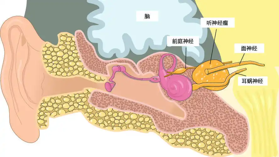 听神经瘤的症状可能不易察觉