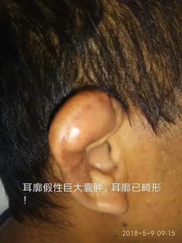 耳朵疾病常见的几种耳内镜照片