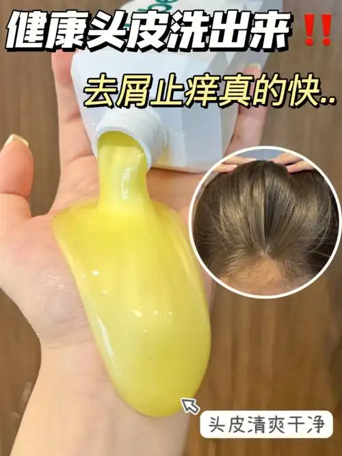 没头屑别用养好头皮皮屑头痒不再来