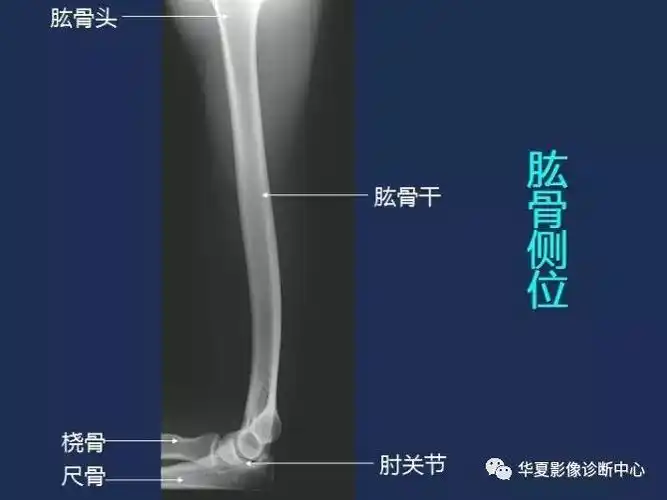 肱骨侧位x线解剖图谱(肱骨)