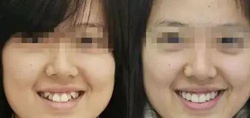 可爱的虎牙能拔吗