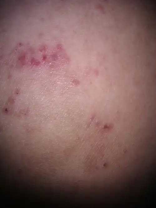 屁股上有些红色的突起,不痛,但是很痒,求看看是什么病