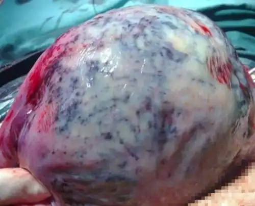 胎盘早剥近四分之三,一分钟把娃抱出 | 夜班故事