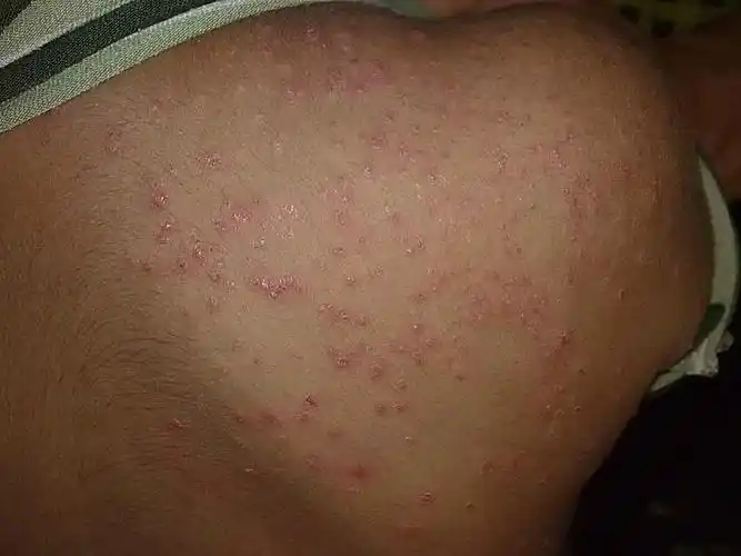 臀部皮肤念珠菌病图片