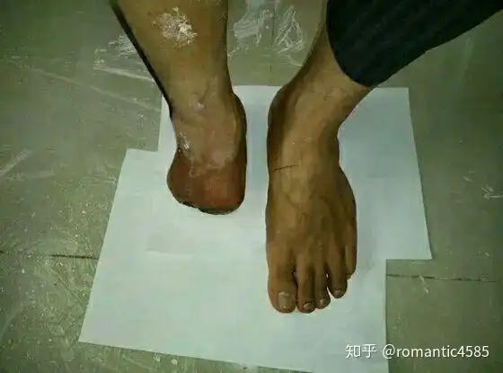 半足截肢患者选择假肢标准介绍(知乎版)
