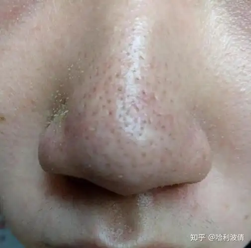 鼻头上的毛孔因为挤了几次黑头而变大还有救吗如果现在停手它会慢慢