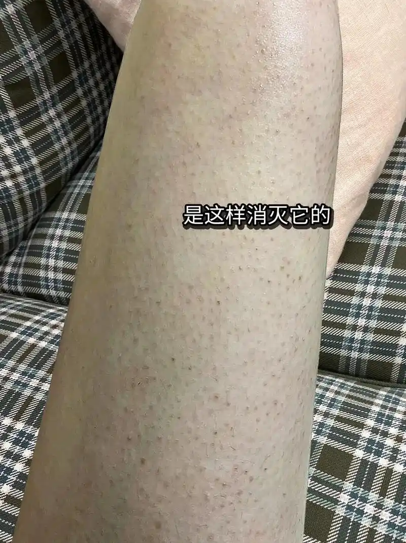 去鸡皮肤小妙招 ,快试试#宝中宝尿素霜 直接涂抹,用完你会 - 抖音