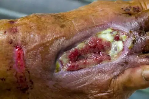 败血症图片 (84)