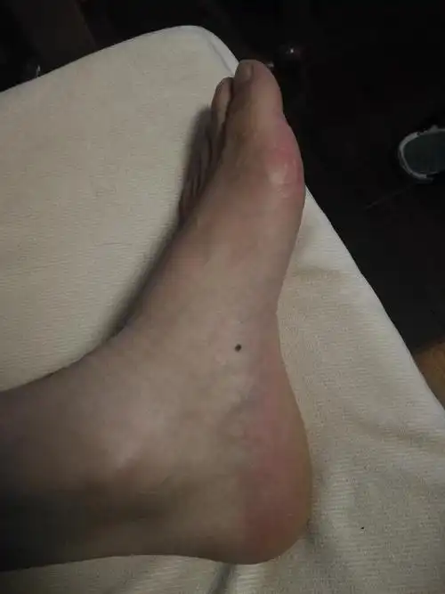 相术:图解——脚上长痣