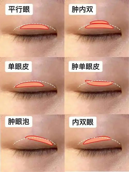 6种双眼皮贴教程60拯救单眼皮肿眼泡