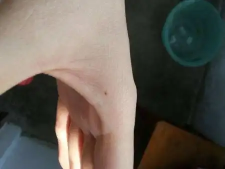 左手虎口有痣右手虎口有痣虎口有痣图解