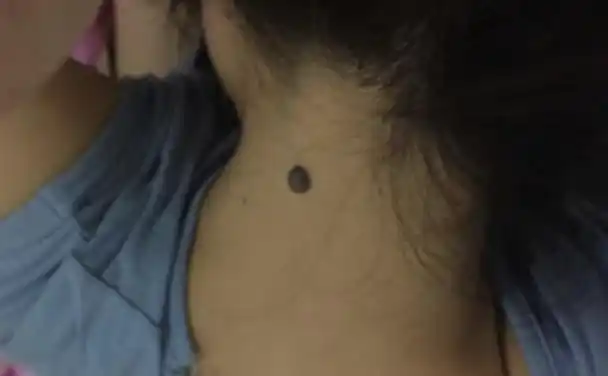 为啥有的人脖子后边有一颗"痣"?是好是坏?真的是巧合吗?