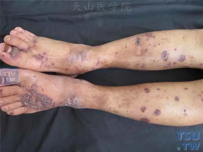 【图】变应性皮肤血管炎的症状表现 - 皮肤病诊断图谱 - 天山医学院