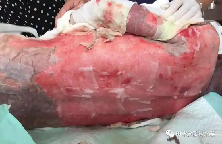 丙戊酸钠致中毒性表皮坏死松解症一例