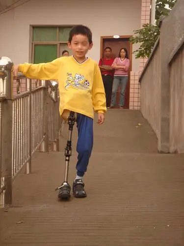 (患者穿戴假肢斜坡行走)