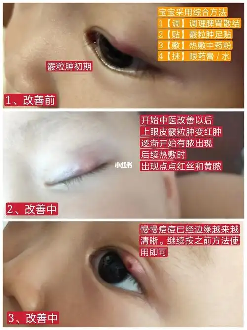 霰粒肿不想手术的逆袭之路_中医_霰粒肿_母婴_育儿经验