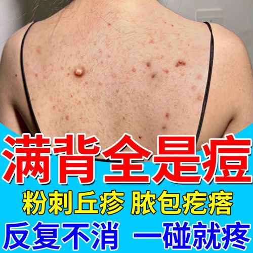 毛囊炎 祛痘药膏】痤疮膏祛痘脓疱疮毛囊炎背上长痘痘前胸后背粉刺