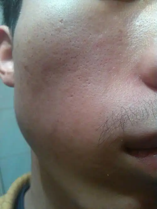 脸上是凹洞还是毛孔粗大,怎么辨认呢?