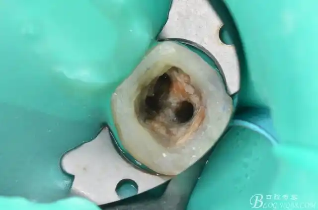 第二磨牙残根橡皮障下rct现代根管治疗培训后的改进